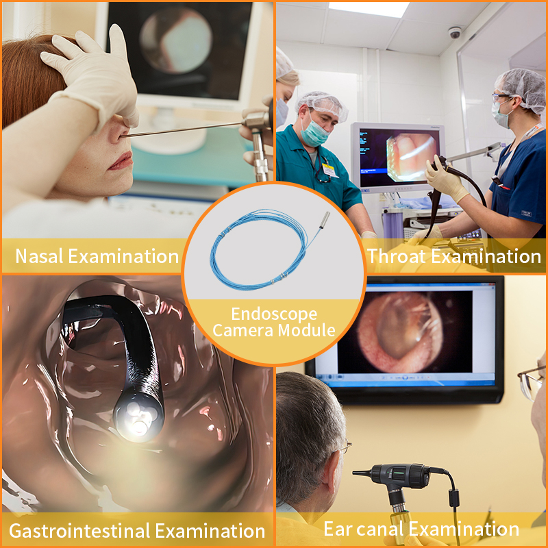 An&aacute;lisis de las ventajas principales del m&oacute;dulo de c&aacute;mara para endoscopio de vista lateral en aplicaciones de histeroscopio