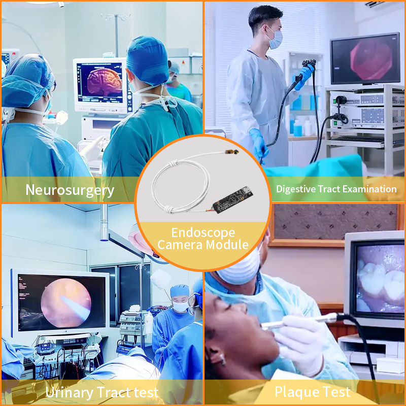 Vantaggi applicativi principali del modulo telecamera endoscopica nella piattaforma chirurgica